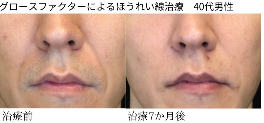 ビフォーアフター
