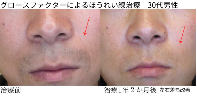 ビフォーアフター