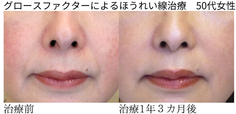 ビフォーアフター