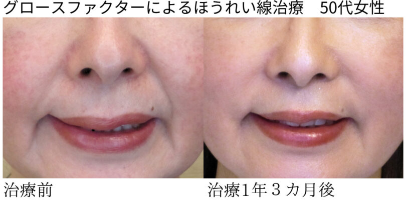 ビフォーアフター