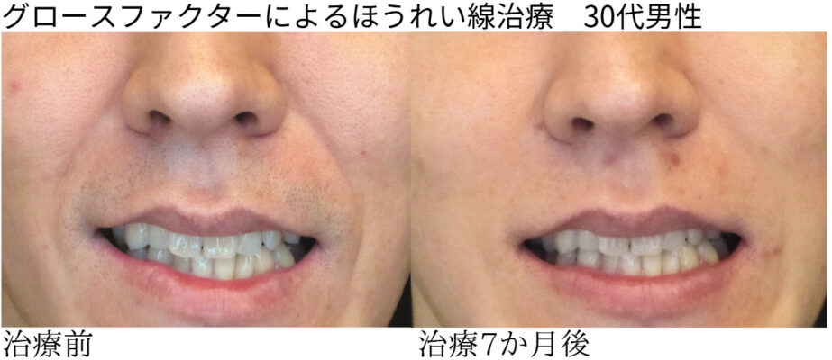 ビフォーアフター