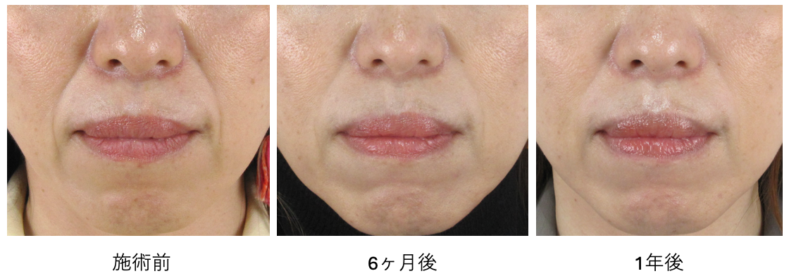 50代前半女性のほうれい線グロースファクター治療前・6か月後・1年後の比較写真